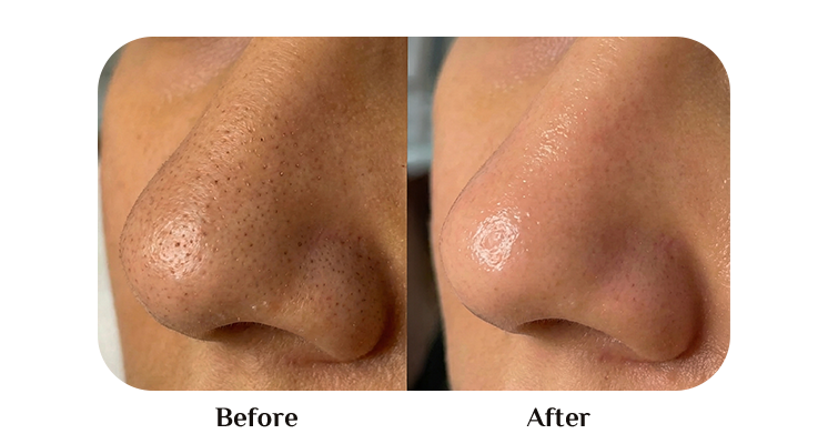 Hydro facial treatment at LB Beauty Spa Miami