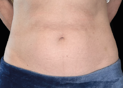 After EMS sculpting — Abdomen & Waist