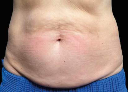 Before EMS sculpting — Abdomen & Waist
