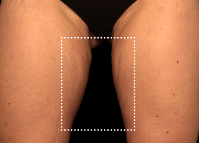 After EMS sculpting — Thighs