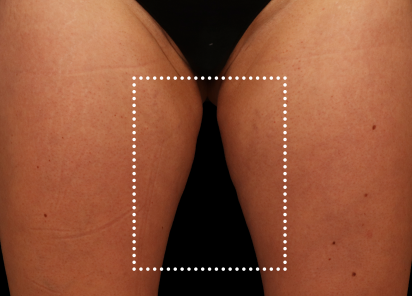 Before EMS sculpting — Thighs
