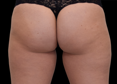 After EMS sculpting — Buttocks