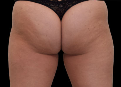 Before EMS sculpting — Buttocks