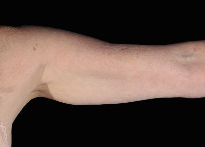After EMS sculpting — Arms