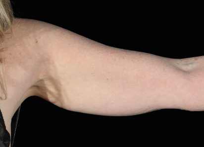 Before EMS sculpting — Arms